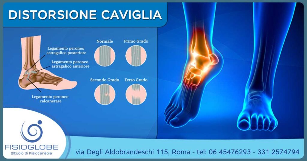 Distorsione della caviglia: rimedi e terapie - Fisioglobe