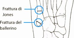 Cosa fare dopo essersi ingessato un piede